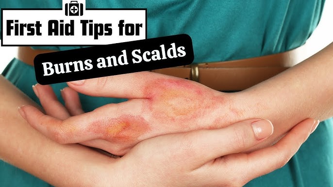 Second-Degree Burns: Symptoms, Treatment, and The Importance of First Aid Training